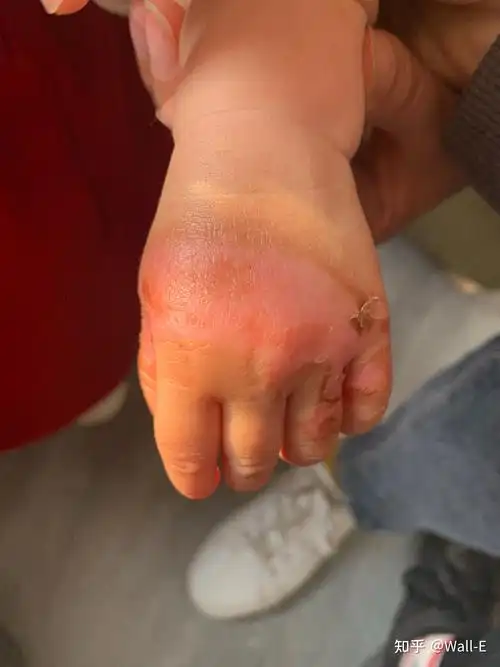 烫伤第一时间怎么处理