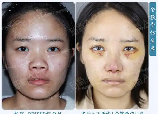 [:13]"binder综合症"又称先天性中面部凹_圈子-新氧美容整形