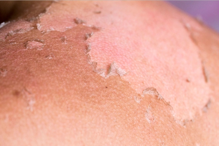 听说你晒黑了?会做晒后修复你还能抢救一下!