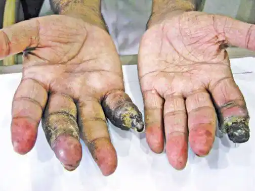 被自家狗舔了一口他暴毙身亡多人因此毁容失去双腿双