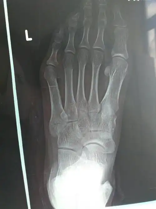 大夫你好,我脚外侧崴了25天了还是不敢走道,一用力就疼,崴脚第二天拍