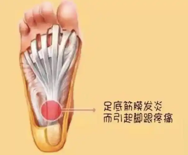 足底筋膜炎最常见的足疼疾病