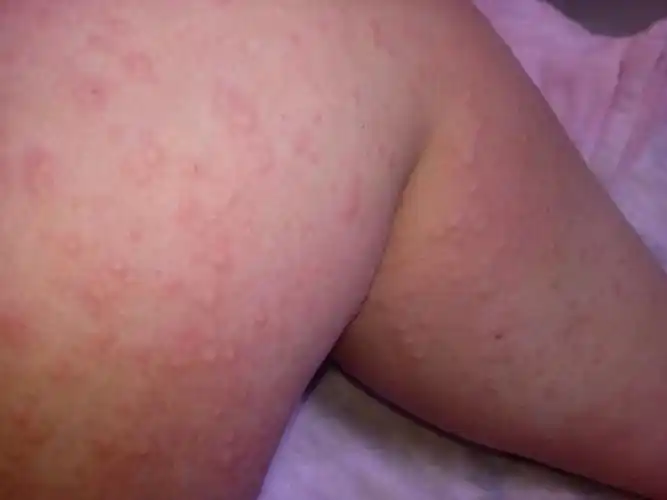 孕妇湿疹怎么办