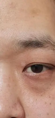 大家帮我看看,我眼角这个是白白吗?