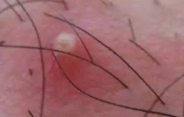 痤疮和毛囊炎完全不是一种病,正确区别,不可一概而论!