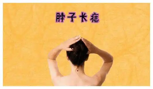 身体5颗"巨富"痣,有一个,将腰缠万贯,万里挑一的好命