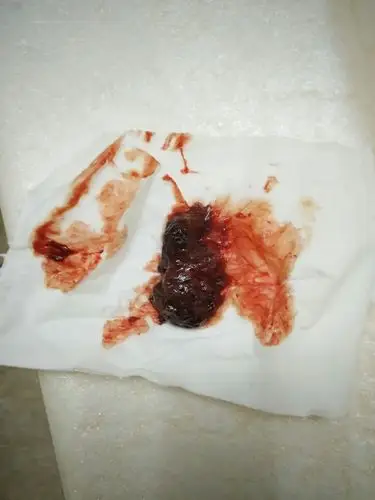 刚刚顺产10天,晚上上厕所的时候排出一团血块,正常吗?