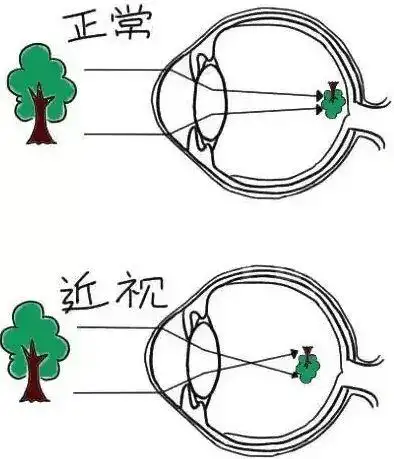 近视眼的成像点在视网膜前,不管是多少度近视,你的成像点都落在了