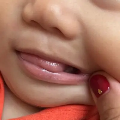 宝宝牙龈外侧长小白点是啥原因?6个月大的孩子,不像是长牙的求助