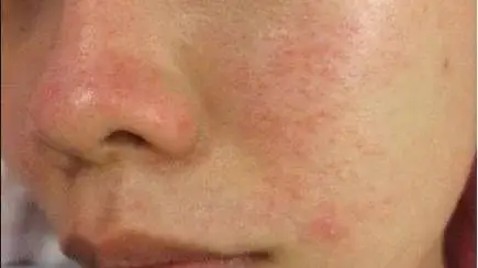 4,个别人脸颊,口周及鼻翼根部容易出现轻微红血丝现象.