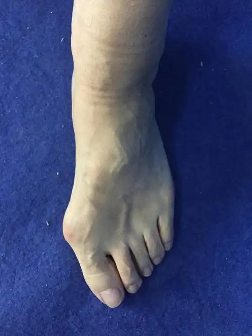 你对拇外翻了解多少_拇外翻_介绍_治疗方式_日常注意事项 - 好大夫