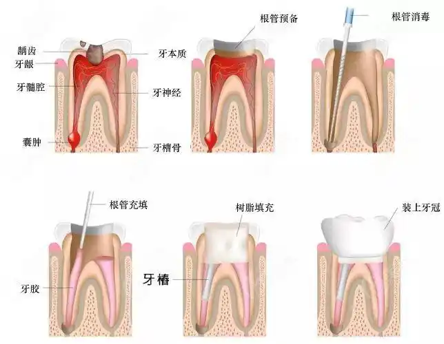 有深度龋齿的牙友们建议来看根管治疗与拔牙的利弊哦