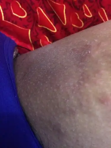 在大腿内侧的这个是什么东西?