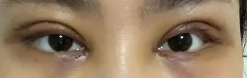 单侧提肌双眼皮快5个月了,我是不是割失败了