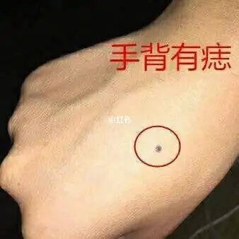 痣图解右手手背上有痣图解女人右手有痣图解大全男人右手手背痣各个