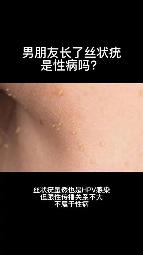 丝状疣它是由人类乳头瘤病毒hpv