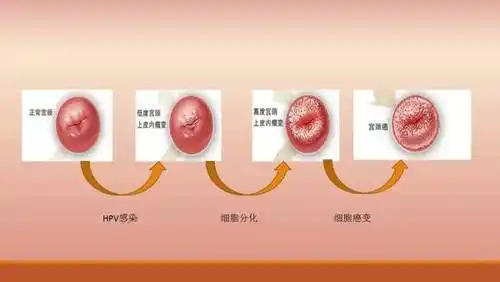4559岁女性注意了这是宫颈癌的高发年龄每年3万女性因它死亡