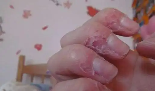 来缓解心中的不良情绪和焦虑感,像是拔毛癖,过度抓挠皮肤,咬指甲等,都