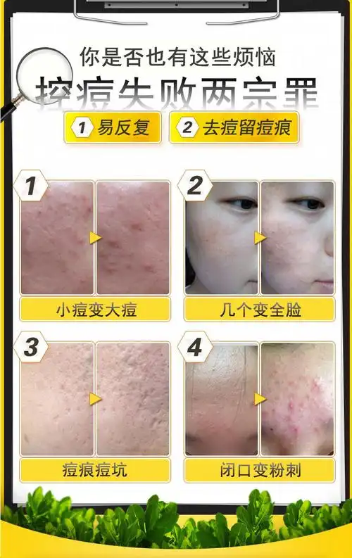 展示与对比:正品露兰姬娜茶树控油祛痘补水保湿洁面乳细致毛孔深沉