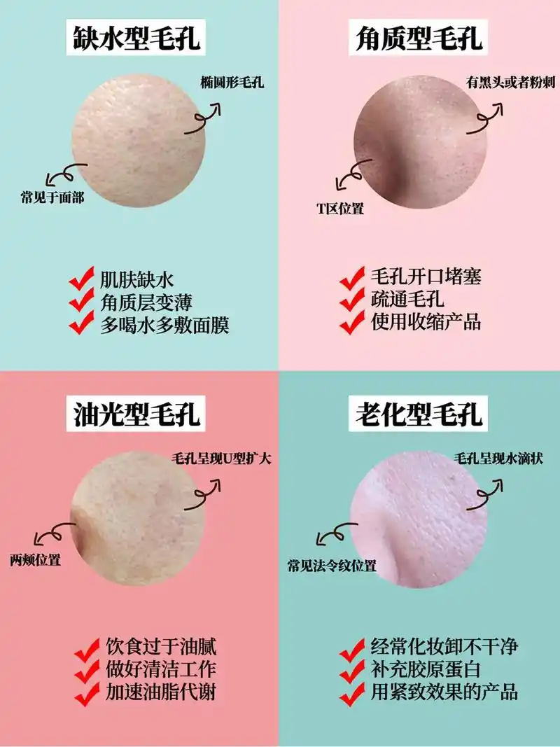 四种毛孔粗大类型!你是哪一种?
