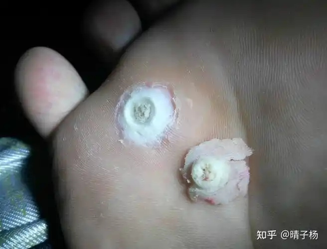 7天:鸡眼已经拔出来了,把周围红色的清理了一下10天:皮肤正在慢慢愈合