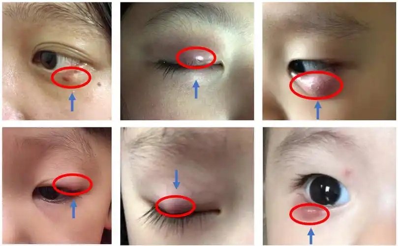 霰粒肿问答之一:什么是霰粒肿?