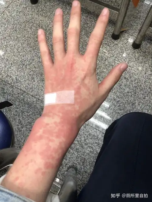 过敏性皮炎一周终于好了01