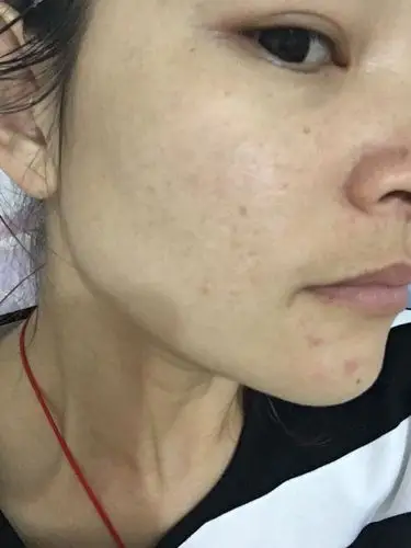 皮肤发黄,发干,粗糙,偶尔冒痘,有痘印怎么办