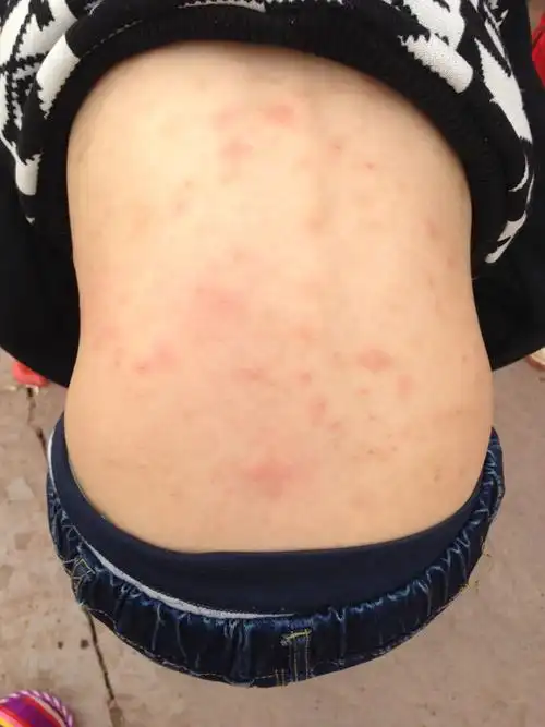 为什么天气热皮肤就出红点(为什么天气热皮肤就出红点痒)