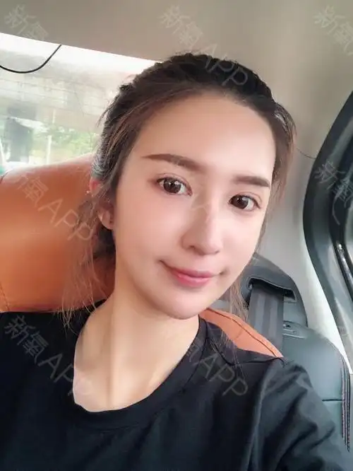 陌小羽自体脂肪全脸填充第15天美丽日记