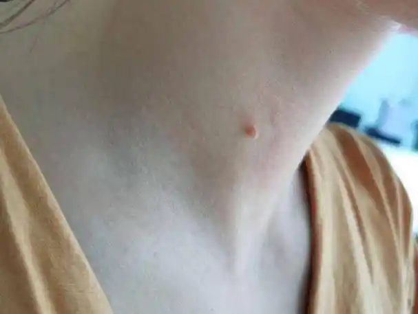 脖子和腋下的"小肉粒"是什么?用手"揪"掉可以吗?涨知识了