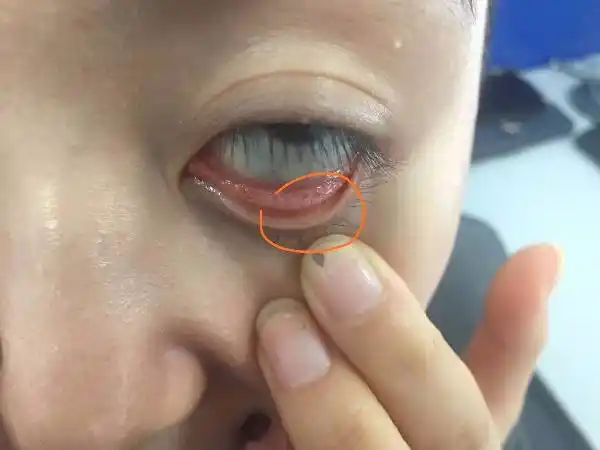 下眼皮里长了个白点磨眼睛,请问是什么症状?有什么影响吗?