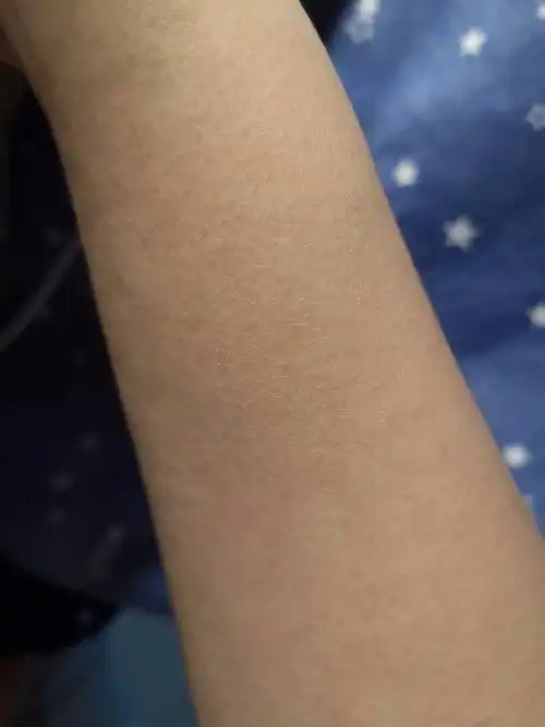 手臂上每个毛孔都鼓起来而且抓抓就痒,半个月了,刚开始一小块抓了抓就