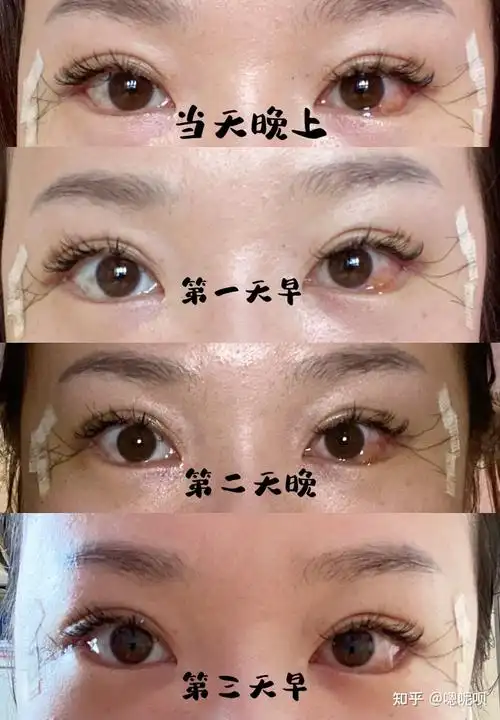 眼睑下至77开外眼角