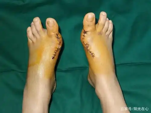 10岁得拇外翻 30岁做手术 这种疾病影响了她的最美青春