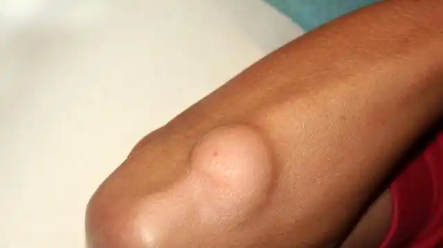 皮肤上长出的"肉瘤"是怎么回事?会癌变吗?