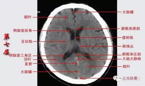 头颅ct断层解剖