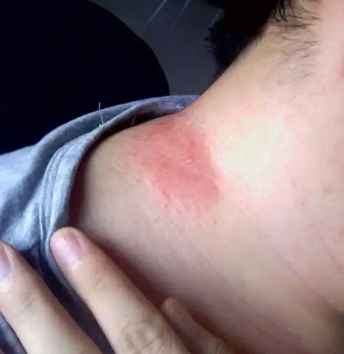 脖子一片红斑,不疼不痒