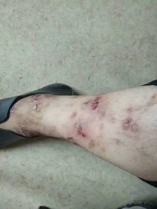 中医治疗顽固性湿疹1例