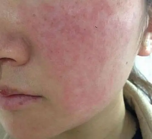脸部皮肤过敏症状图片