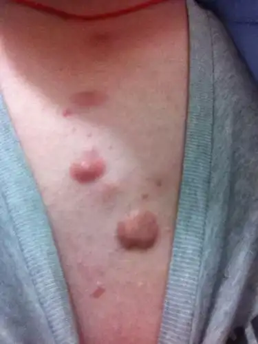 胸口起了几个很大的豆豆…一开始是一个,后来发展到几个了…不疼偶尔