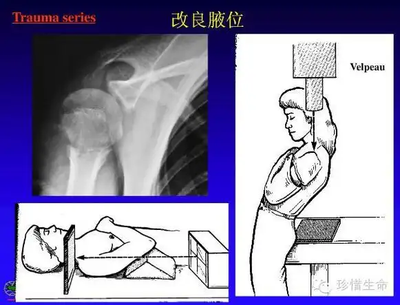 ap in internal rotation肩胛骨内旋正位六ap view 肩关节正位(胸片位