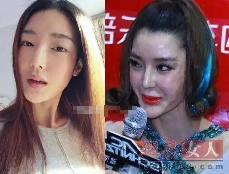 做隆胸手术死亡 细数整容失败女星最惨丧命