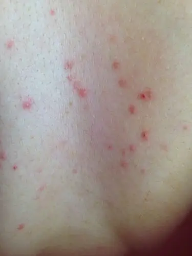 女28未婚,上个星期胸口乳沟正中长了四颗红色点点,有点像痘痘,但又痛