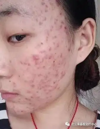 脸上痘痘的生长周期有多长?