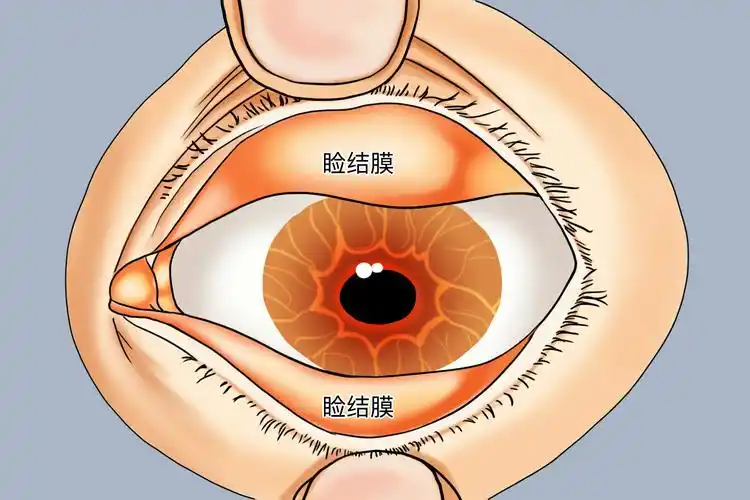 睑结膜图