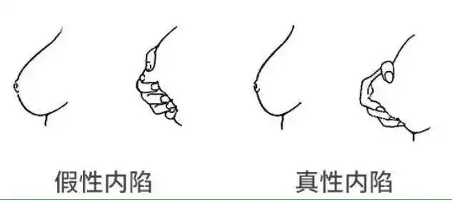 女性乳头多大算正常答案可能出乎你的意料
