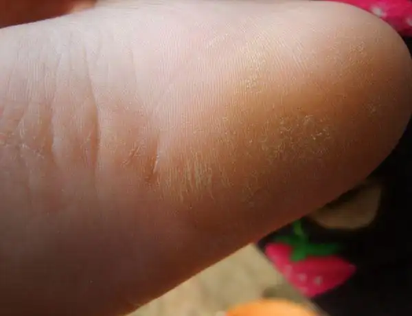 麻烦哪位帮忙看下我小孩的脚底是怎么回事,谢谢