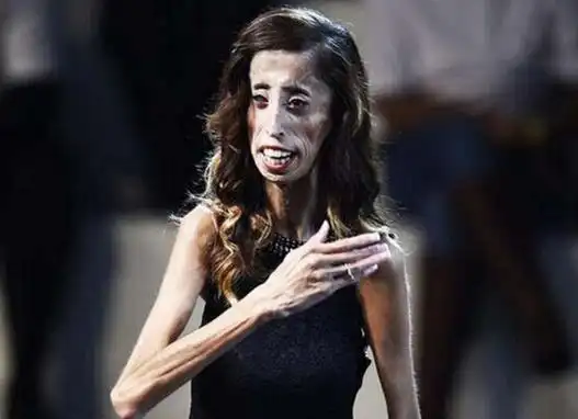 世界上最瘦的女人俄罗斯女孩仅20公斤曾被误认成干尸