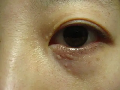 下眼皮有小白点怎么回事?